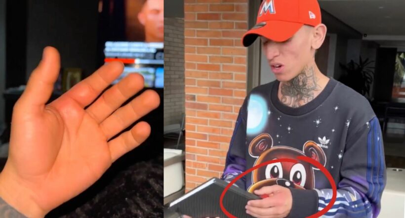 La Liendra muestra con un video cómo tiene su mano por mordida de perros