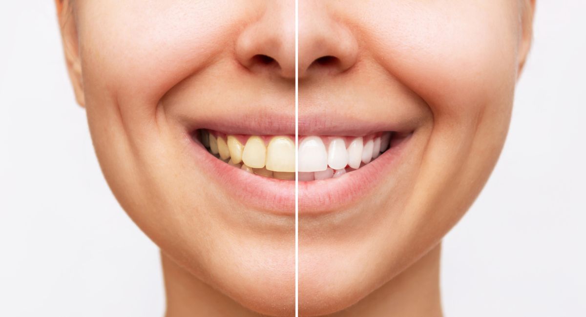 Cómo blanquear los dientes de forma natural en casa; bicarbonato, aceite y  más