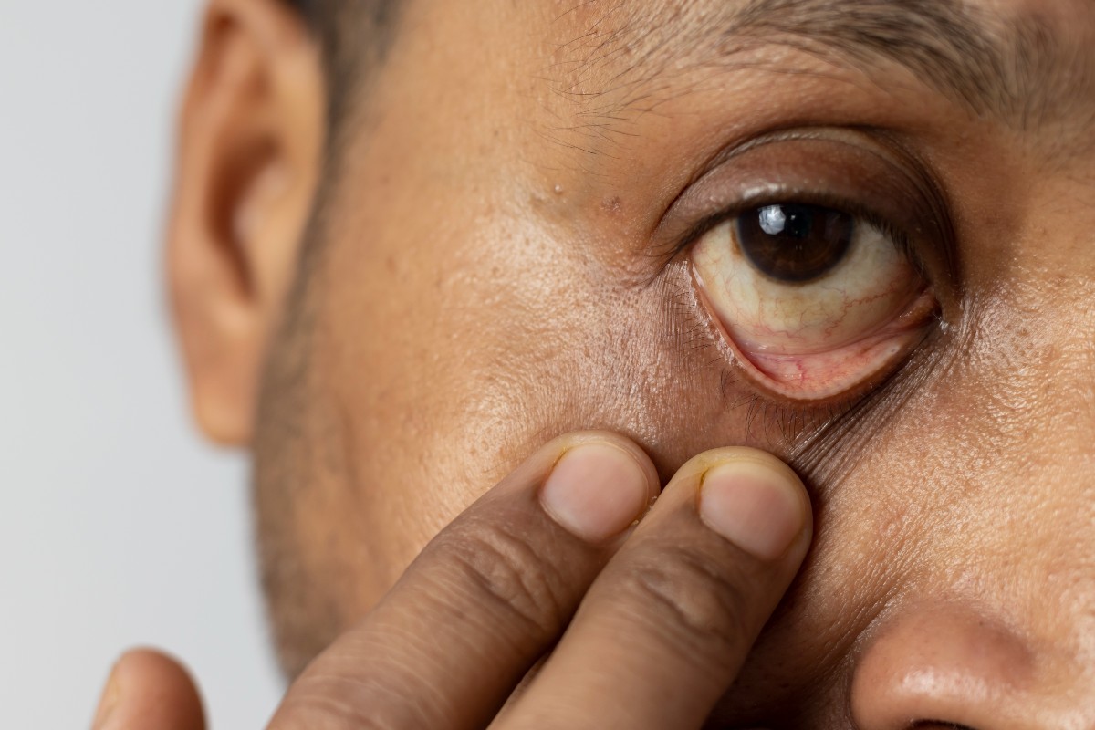 En algunos casos, el cáncer también puede diseminarse desde el ojo hasta otras partes del cuerpo.
