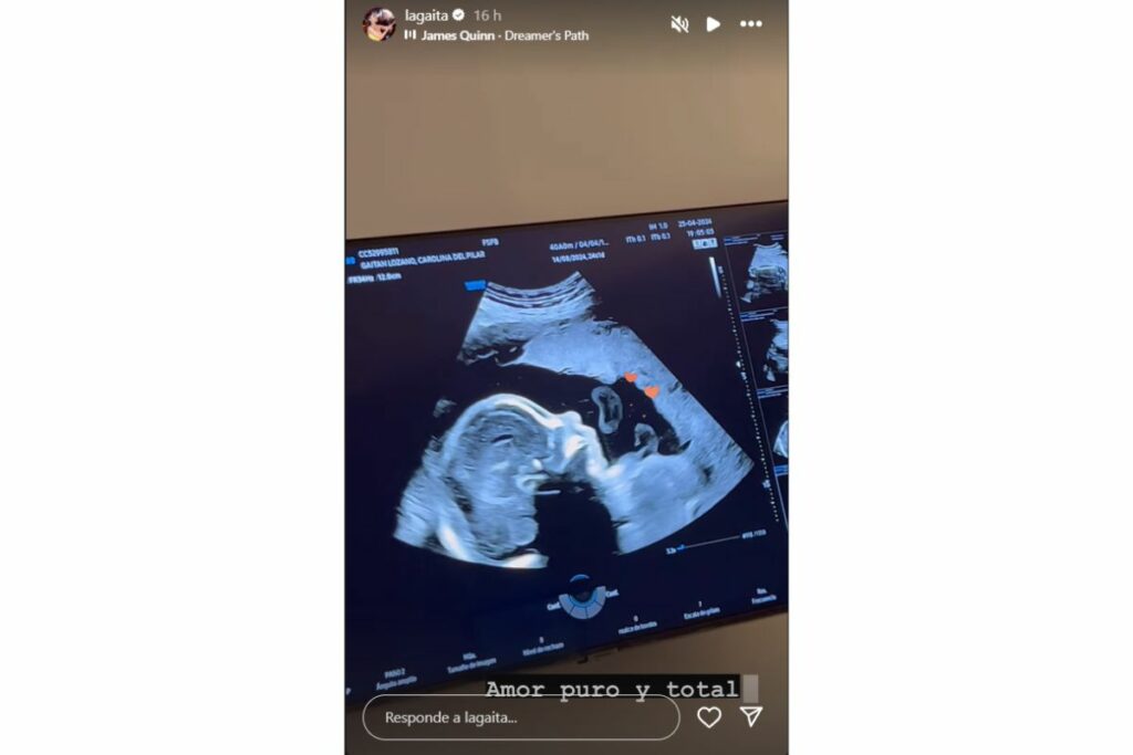 Carolina Gaitán mostró la cara de su hijo en ecografía. Está creciendo sano / captura de pantalla instagram @lagaita