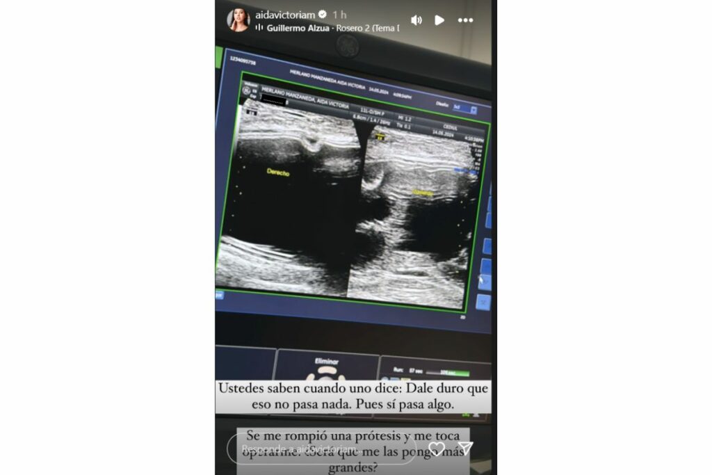 Aída Victoria Merlano, dirécto al quirófano por prótesis  de pecho dañada / captura de pantalla instagram @aidavictoriam