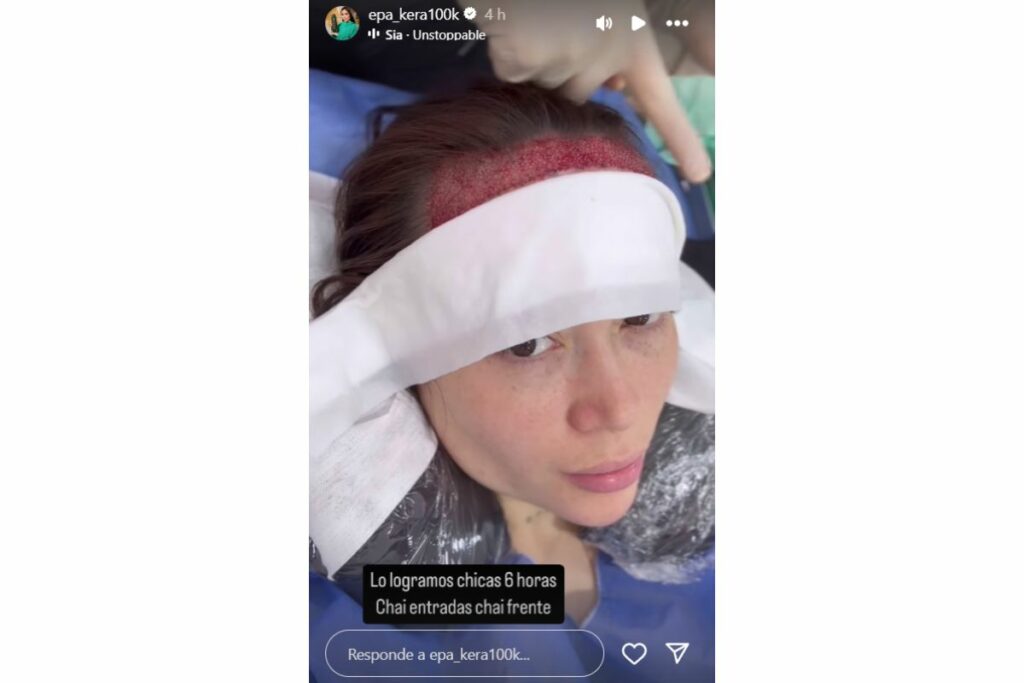 'Epa Colombia' se hizo implante de cabello y mostró procedimiento / captura de pantalla instagram @epa_keratinas