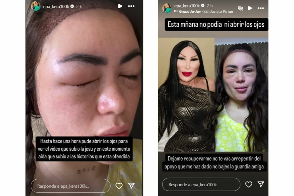 'Epa Colombia' tuvo complicaciones con su operación estética y no abre los ojos / captura de pantalla instagram @epa_keratinas