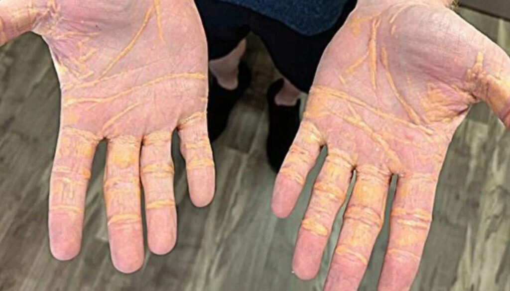 Xantoma por exceso de grasas - Jama Cardiology
