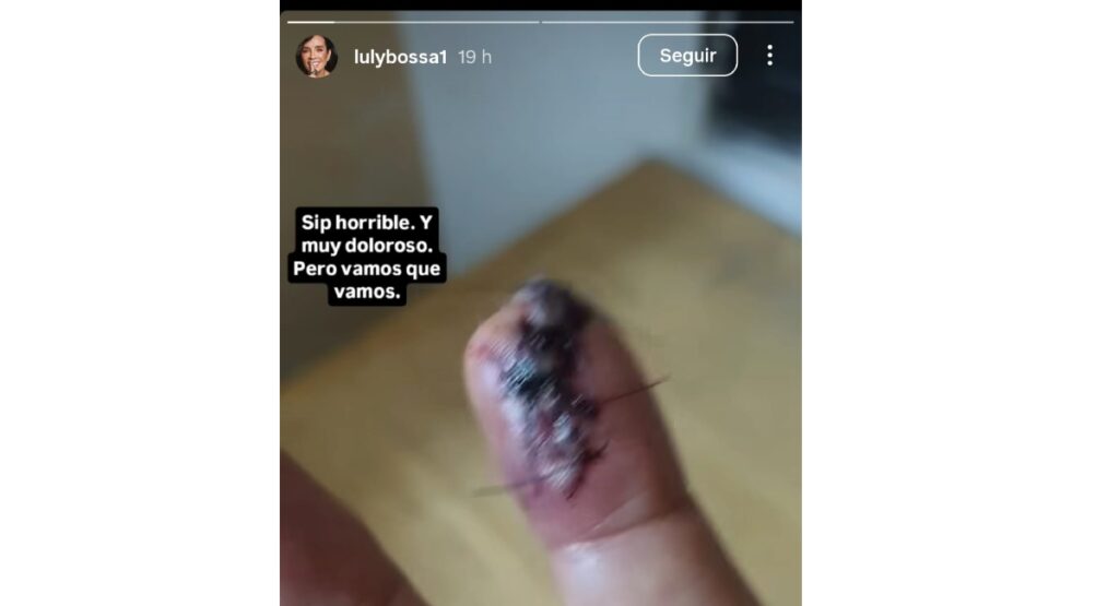 Dedo de Luly Bossa / Captura de pantalla de Instagram: @lulybossa1