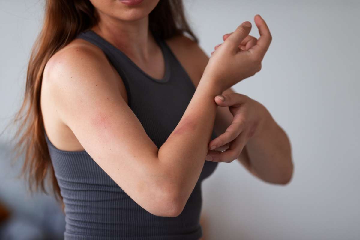 Foto de dermatitis atópica, en nota de qué es dermatitis atópica, enfermedad con pacientes en Colombia y duros efectos