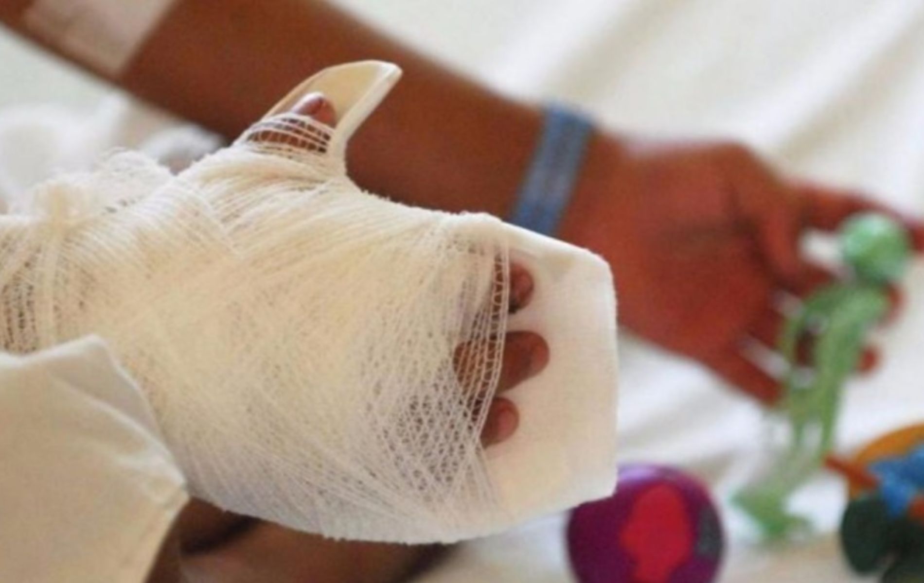 Cuántos quemados con pólvora se registraron por Día de Velitas 7 de diciembre