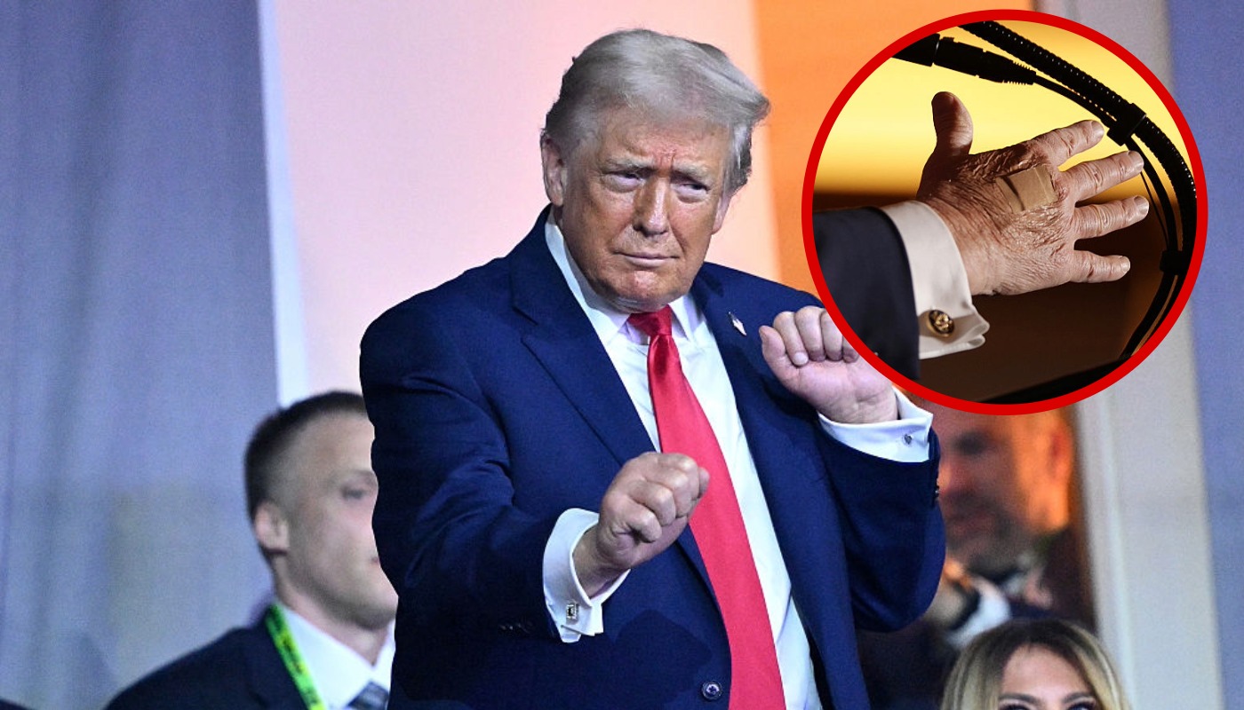 Qué pasó con las manos de Donald Trump: vendajes del presidente de EE. UU