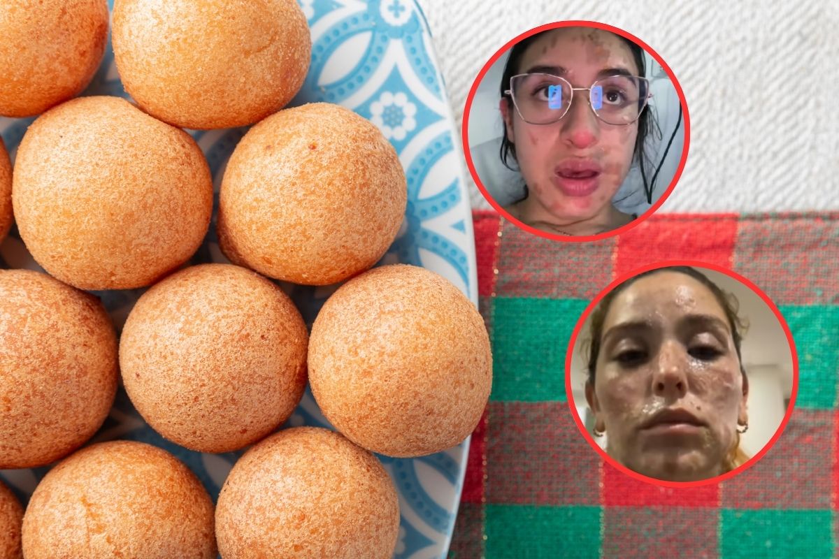 Jóvenes en Bogotá se queman la cara haciendo buñuelos: contaron sus casos