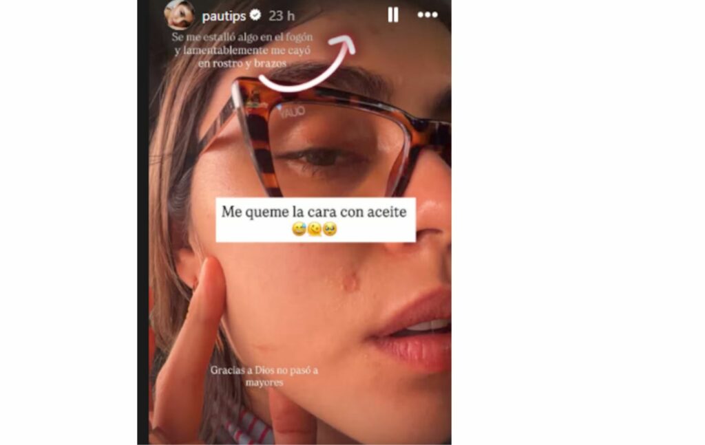 Participante de 'Masterchef 2026' 'Pautips' sufrió quemaduras en rostro