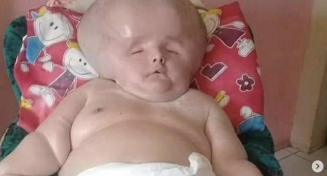 Así se ve la mujer de 29 años que tiene hidrocefalia: le dicen la bebé gigante