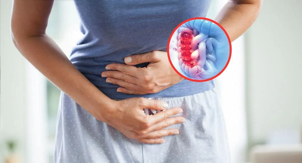 Científicos descubrieron cuatro síntomas para el diagnostico de cáncer de colon en personas menores de 50 años de edad; estas son sus causas