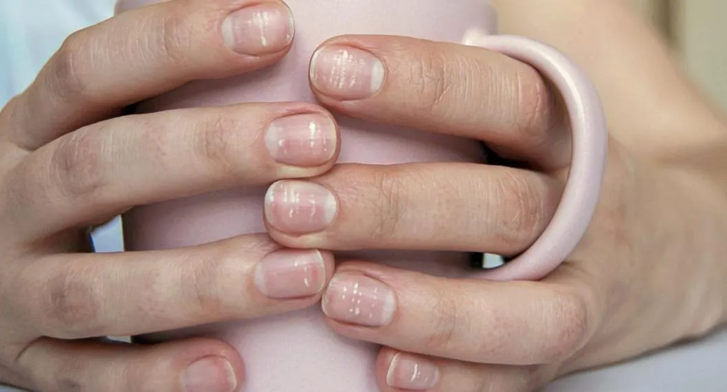 En las uñas se pueden reflejar enfermedades relacionadas con la anemia, el lupus y la neumonía; estas son las características que debe tener en cuenta