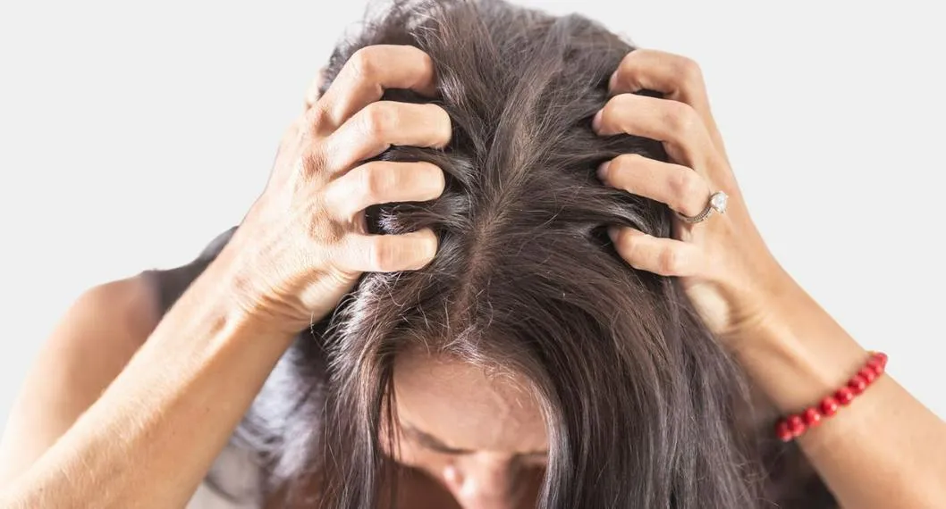 10 remedios para quitar la caspa del cabello naturalmente; el portal Business Insider explicó las causas de este problema en el cuero cabelludo