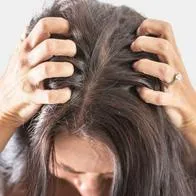 10 remedios para quitar la caspa del cabello naturalmente; el portal Business Insider explicó las causas de este problema en el cuero cabelludo