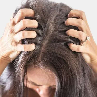 Remedios para quitar la caspa del cabello naturalmente, por qué sale y  consejos