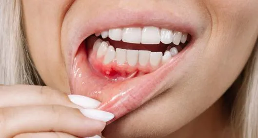 Usar bicarbonato de sodio para blanquear los dientes puede causar irritación y sensibilidad si se aplica con mucha frecuencia y si se mezcla con productos de pH ácido