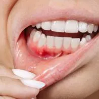Usar bicarbonato de sodio para blanquear los dientes puede causar irritación y sensibilidad si se aplica con mucha frecuencia y si se mezcla con productos de pH ácido