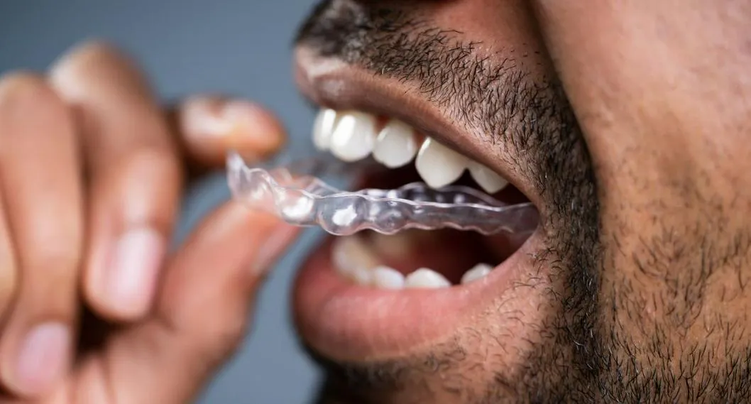 Los alineadores invisibles sirven para alinear los dientes, pero la ortodoncista Gloria Rivera dice que no ayuda a tener una mordida funcional