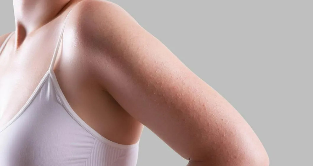 Los granos de los brazos suelen aparecen por cambios hormonales en la pubertad o la menopausia; estos son 3 exfoliantes caseros que se pueden usar 