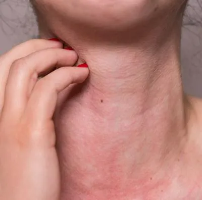Mujer en Estados Unidos dice ser alérgica a su novio e historia se hace viral