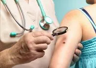 Cómo detectar los melanomas en los lunares, un tipo de cáncer de piel agresivo y letal si no es detectado a tiempo.