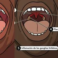 La peligrosa bacteria que provocó que joven paisa perdiera todas sus extremidades