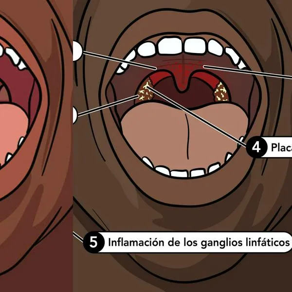 La peligrosa bacteria que provocó que joven paisa perdiera todas sus extremidades