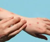 Alerta por 137 casos de varicela en Armenia, autoridades intensifican monitoreo