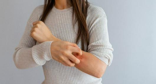 Cómo reconocer la dermatitis y de qué manera prevenir la enfermedad