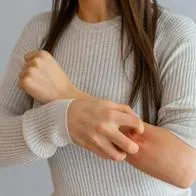 Cómo reconocer la dermatitis y de qué manera prevenir la enfermedad
