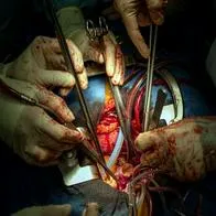 Cirujanos realizan el segundo trasplante de corazón de cerdo a un humano