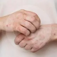 ¿Qué es la culebrilla? La enfermedad que puede aparecer después de la varicela 