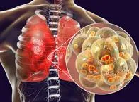 Enfermedades respiratorias: ¿qué hacer y cómo prevenirlas?