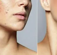 Cómo eliminar el acné de forma rápida y permanente; algunas causas y consejos