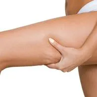 Este tipo de protuberancia se presenta en zonas como las piernas, glúteos, pecho y abdomen.