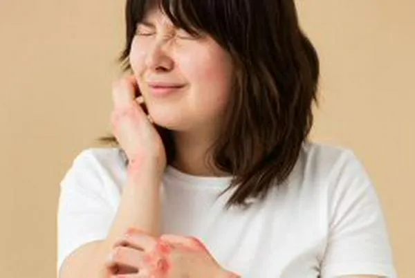 ¿Sufre de urticaria crónica espontánea?
