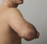Recomendaciones para sobrellevar la urticaria