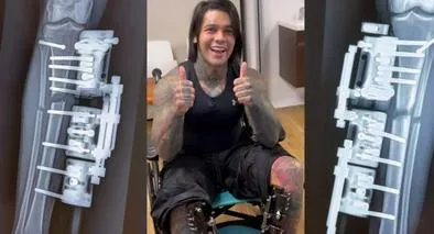 Yeferson Cossio mostró avance de su cirugía de alargamiento de extremidades
