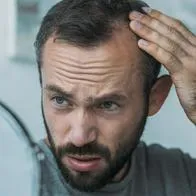 En cuanto a la alopecia arata hace referencia al patrón de pérdida de cabello que se presenta en pequeñas placas redondeadas de alopecia .