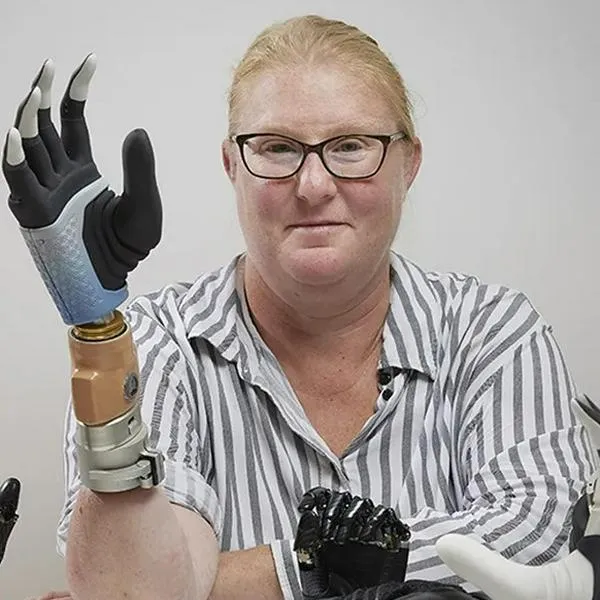 Mia Hand: la mano biónica que hace historia en la medicina