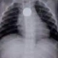 Niño que se tragó una moneda de $ 200 en Cesar no fue atendido por falta de especialistas,. Fue trasladado a Barranquilla para que le salven la vida.