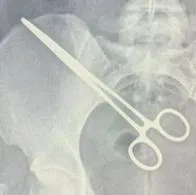 Mujer descubrió que tenía una pinza en la pelvis tras visitar al marido en la cárcel, ¿cómo llegó ahí?