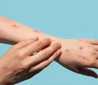 La forma en la que se reactiva la varicela en los adultos