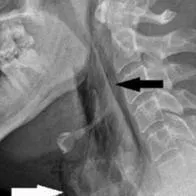 Historia viral: un conductor se contuvo de estornudar mientras iba al volante y terminó fracturándose la tráquea. Es un hito historico en la medicina.