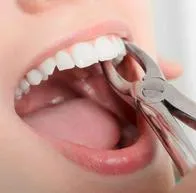 Foto de odontología, en nota de qué no se puede hacer cuando le sacan una muela: estos son los pasos a seguir