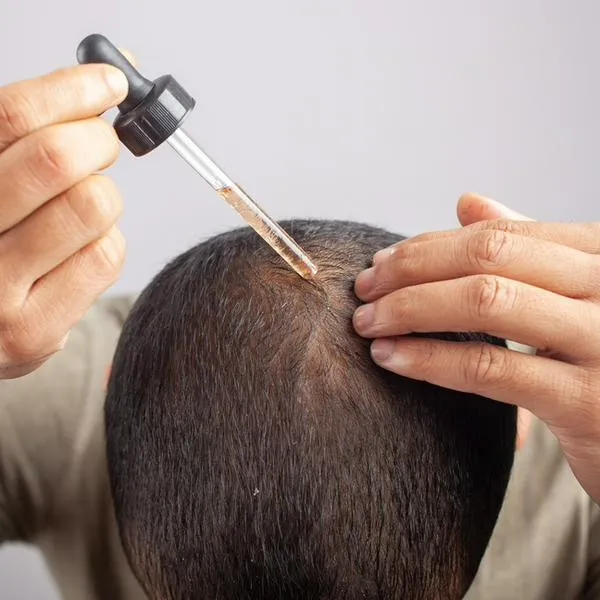 Qué tan bueno es Minoxidil para la calvicie y qué riesgos tiene