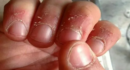 ¿Cómo me quito los ´padrastros' de las uñas? Con aceite mineral y agua tibia