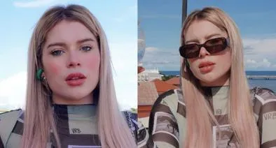 Ornella Sierra tiene enfermedad en la piel: qué es y cuáles son sus síntomas
