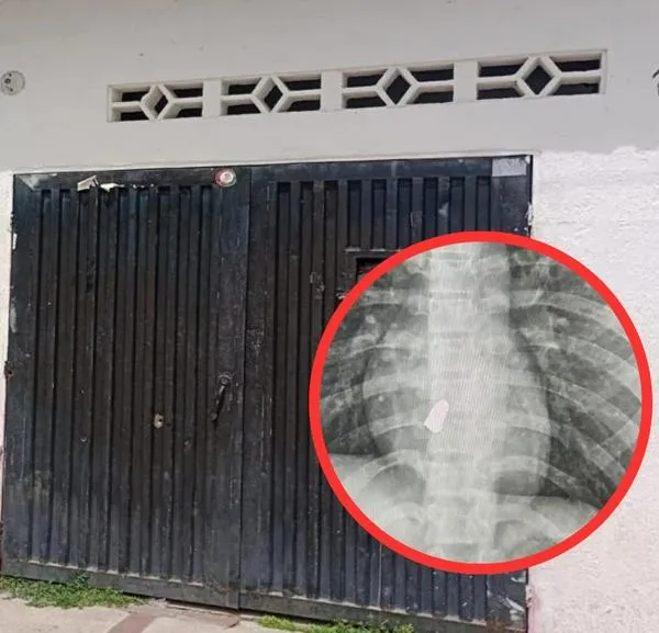 Adolescente de 15 años recibió bala perdida y está grave en hospital de Neiva